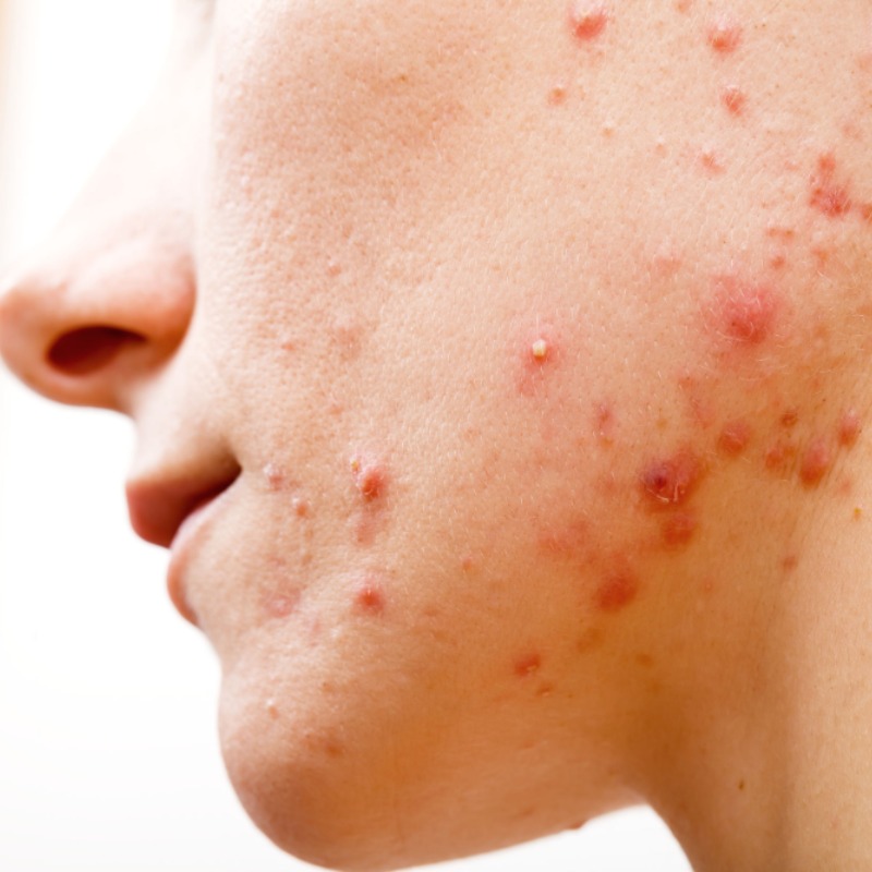 Zuinig ga werken Verandering Acne - Dermea - Hoe ontstaat acne en wat kan ik ermee?